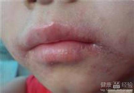 光线性唇炎
