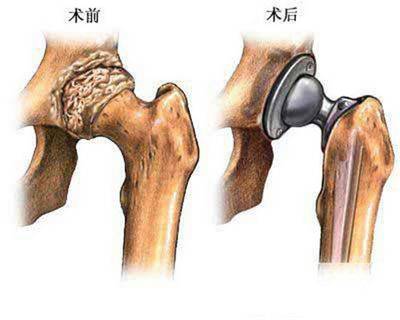 膝髋关节置换