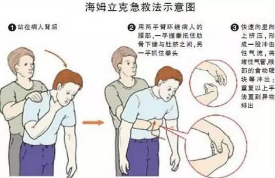 海姆立克的拥抱