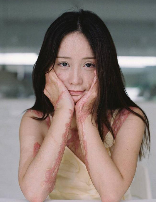 周岩（安徽撮镇中学被毁容案受害者）