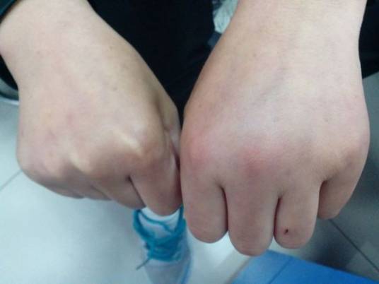 轻伤（医学术语）