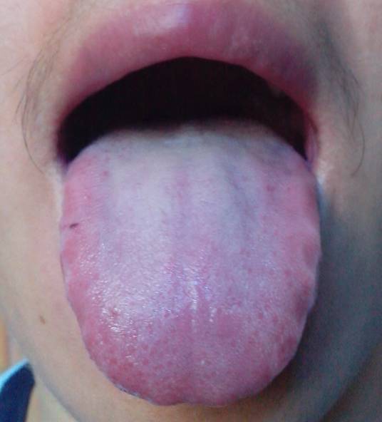 舌苔