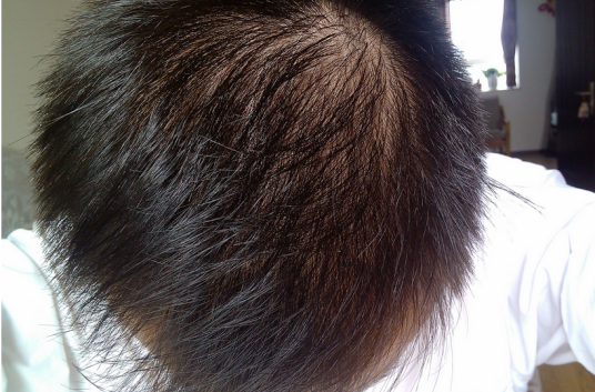 生发（头发的新增）