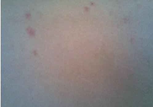 身上有小红点是什么原因？