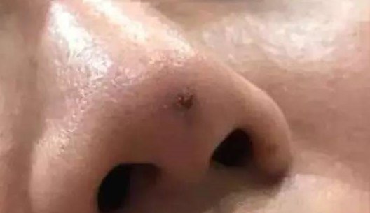 线雕隆鼻图片、线雕前后对比照片、线雕失败毁容图片？