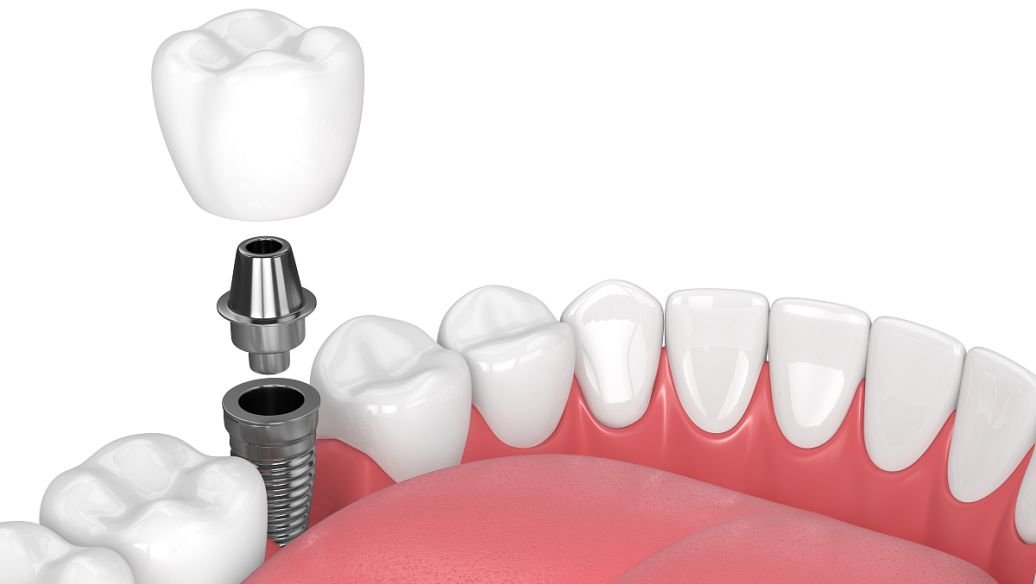 国家医保局称仅一成公众不支持种植牙价格管理，植牙价格管理有何影响？