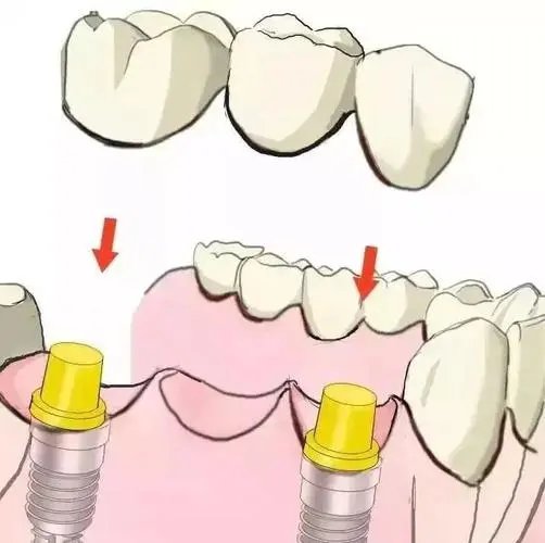 国家医保局称仅一成公众不支持种植牙价格管理，植牙价格管理有何影响？