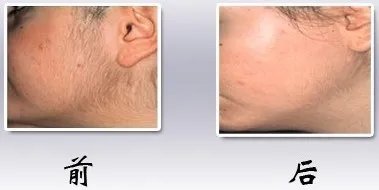 光子脱毛脸部的价格