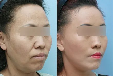 自体干细胞除皱价格