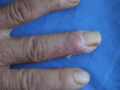 脓疱性肢端皮炎脱屑图片