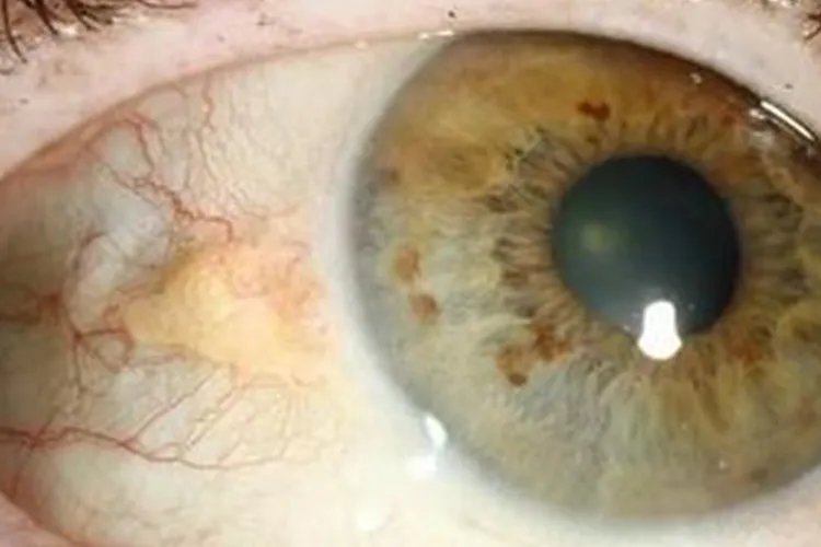 眼白长了个凸起小疙瘩图片