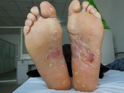 脓疱性肢端皮炎脱屑图片
