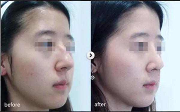 北京耳软骨隆鼻口碑好的医院是哪家