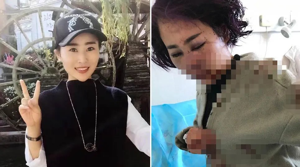 丽江被打女子做伤情鉴定结果怎么样？