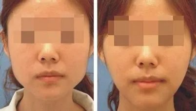 注射瘦脸针多少钱