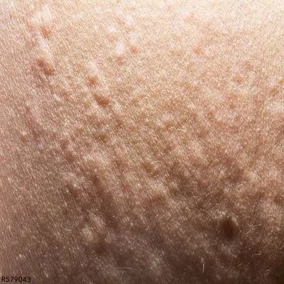 人工性荨麻疹主要症状有哪些