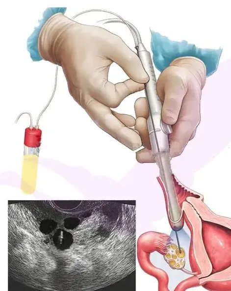 五细胞胚胎可以移植吗？胚胎移植的标准是什么？