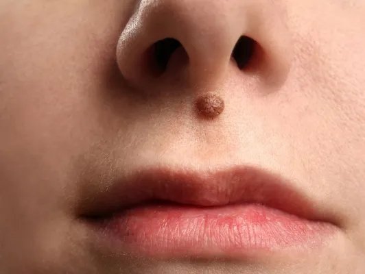 专业去痣术后注意事项