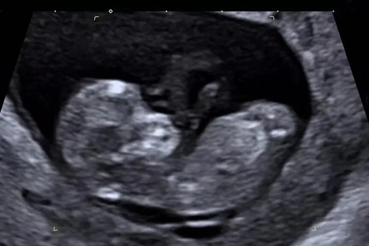 怀孕82天胎儿图片