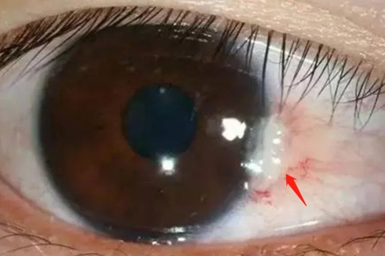 眼白长了个凸起小疙瘩图片