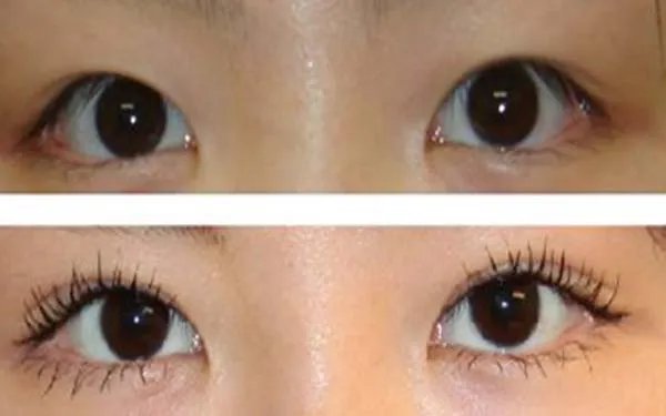 深圳割双眼皮多少钱