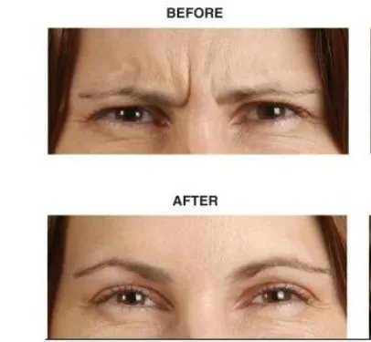 眉间皱纹如何去除