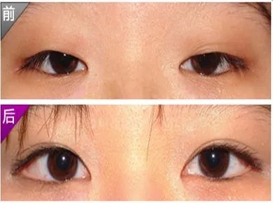开眼角手术前后对比