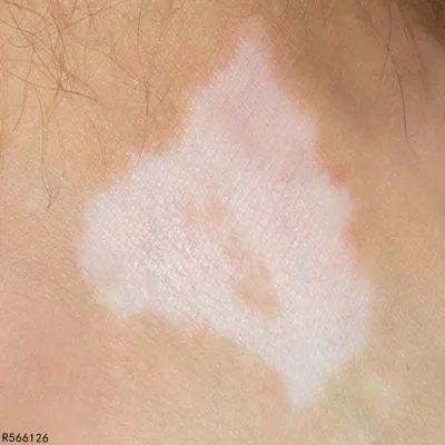 白癜风要做什么检查