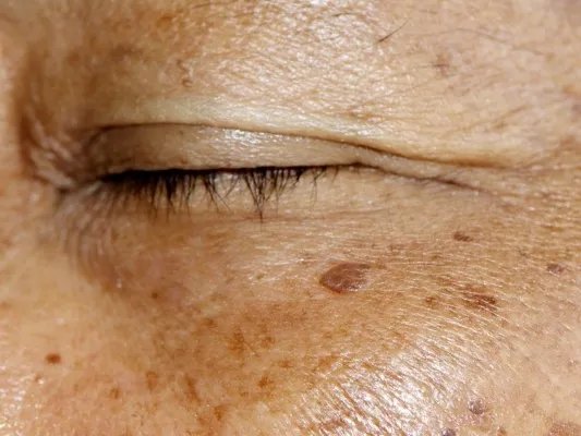 怎样去除面部黄褐斑