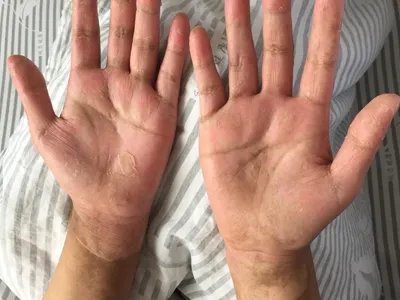2级手足综合征脱皮图片