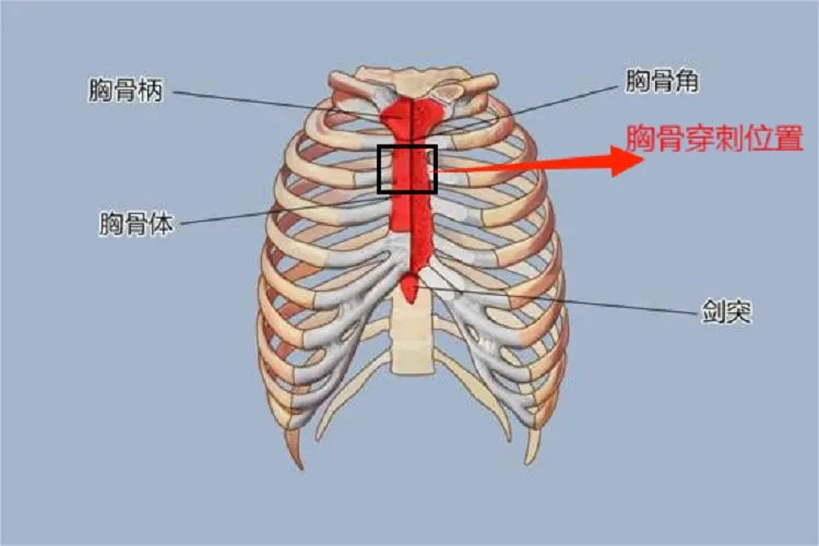 儿童胸骨骨穿位置图片
