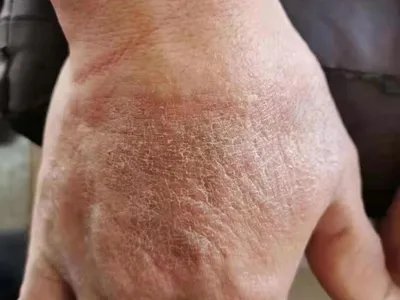 手部湿疹手背皮肤粗糙图片