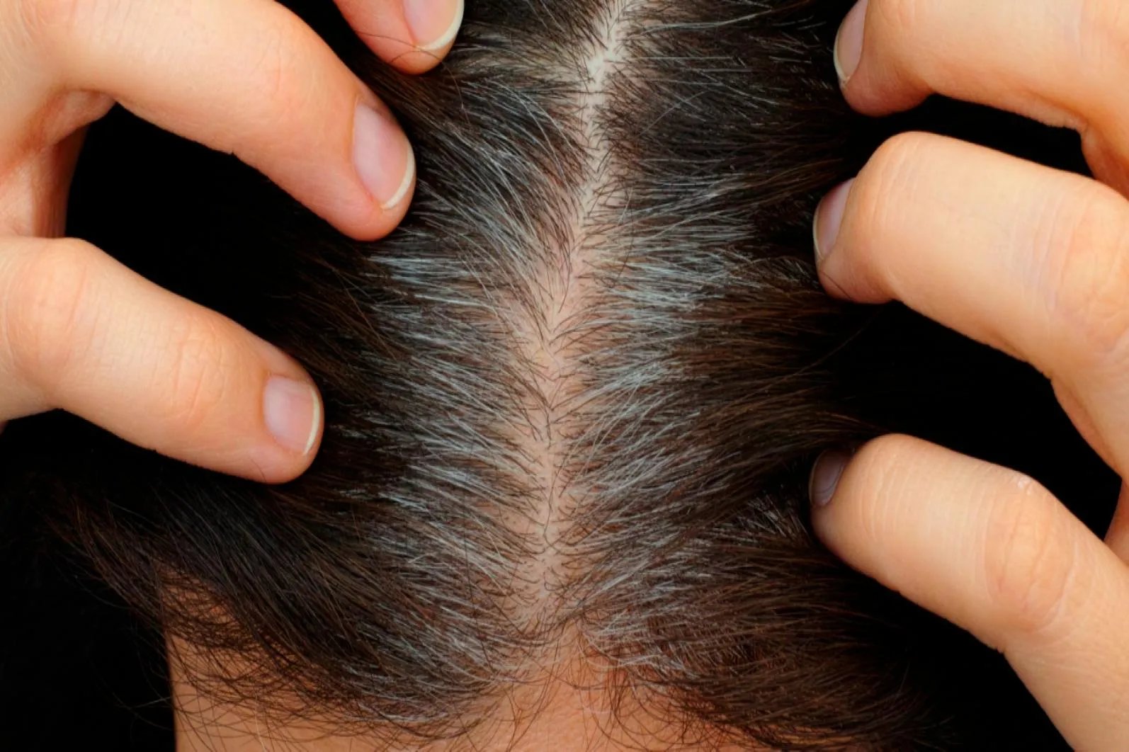 正常毛囊和不正常毛囊图片