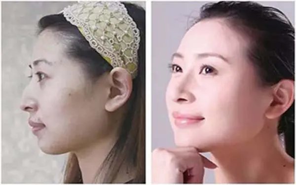 面颊塌陷可做哪种面颊部填充