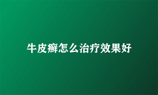 牛皮癣怎么治疗效果好