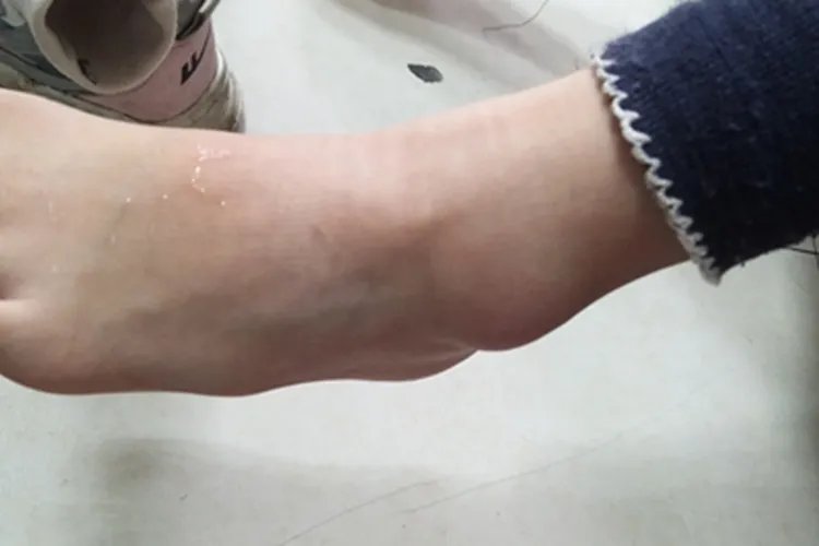 跌伤脚踝症状图片