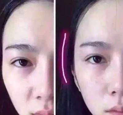 自体脂肪填充面部