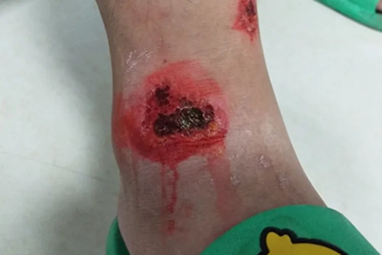 跌伤脚踝症状图片