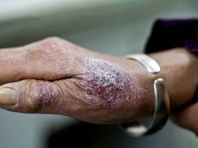 手部湿疹手背皮肤粗糙图片