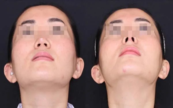 北京耳软骨隆鼻口碑好的医院是哪家