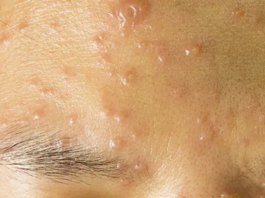 右脸长痘痘是什么原因