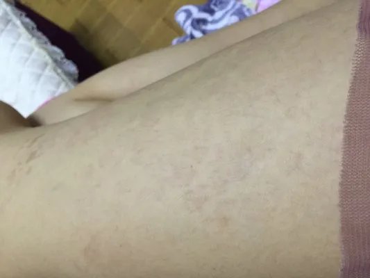 皮肤过敏和湿疹有什么区别？