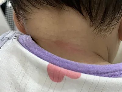 间擦疹后颈红斑图片