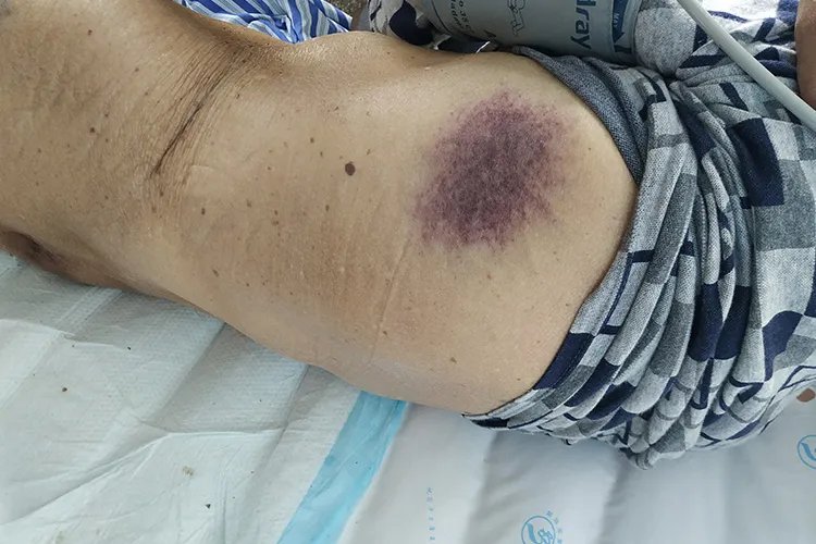 白血病早期图片