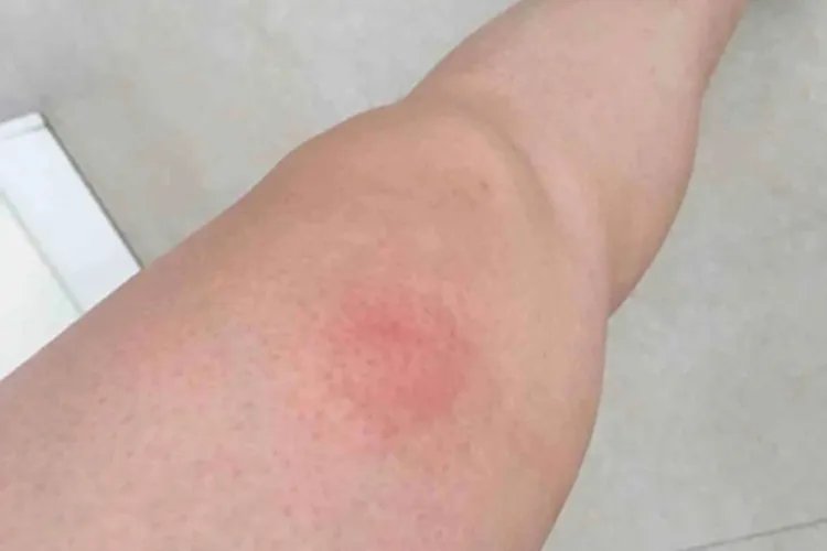 硬红斑大腿红斑图片