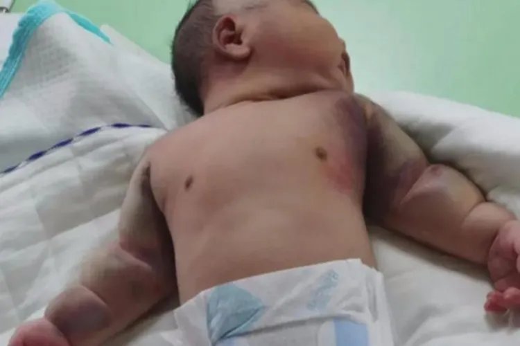 白血病早期图片