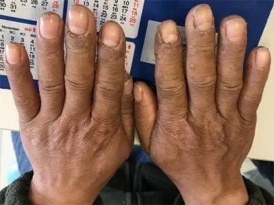 手部湿疹手背皮肤粗糙图片