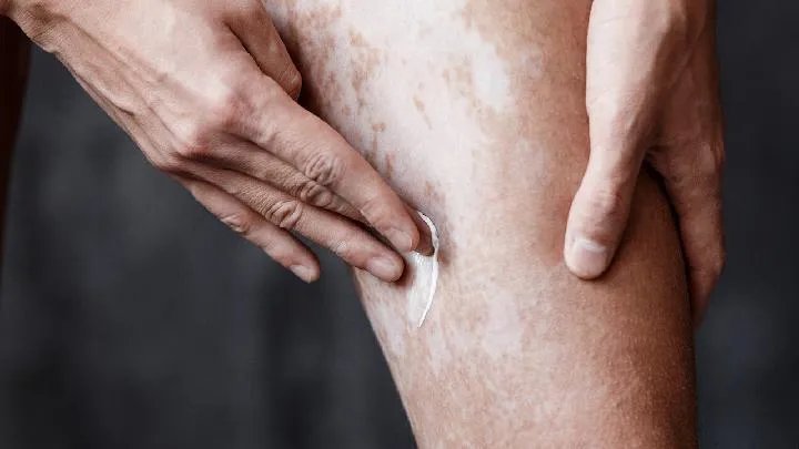 治疗白癜风的方法有哪些呢？