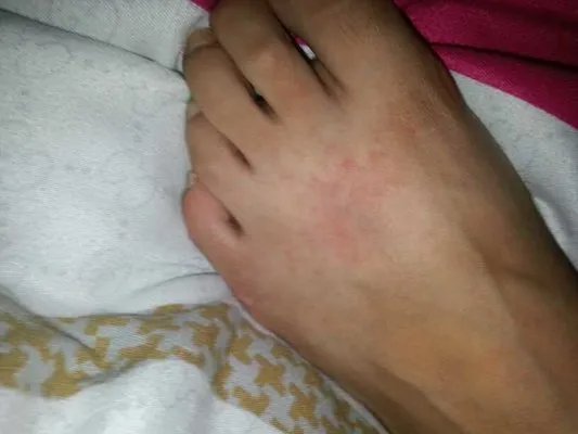 皮肤过敏和湿疹有什么区别？