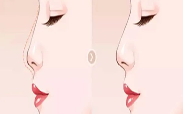 北京耳软骨隆鼻口碑好的医院是哪家